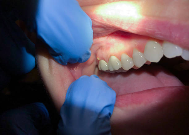 Best Emergency Treatment for Dental Infections or Abscesses in Nashville, AR